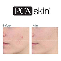 voor en na onzuivere huid met acné gel van pca skin