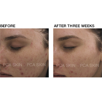voor en na pca skin acné gel 