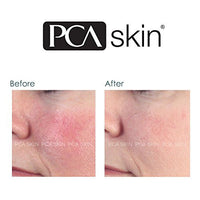 PCA skin | Anti-Redness Serum - vermindert rode huid