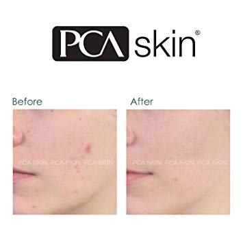 voor en na onzuivere huid met acné gel van pca skin