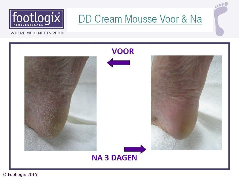 Footlogix | DD Double Defense Cream Mousse voor droge voeten met eelt