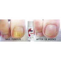 footlogix nail tincture spray voor en na