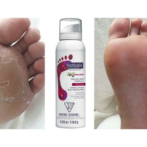 Peeling Skin Formula tegen vervellende voeten en voetschimmel