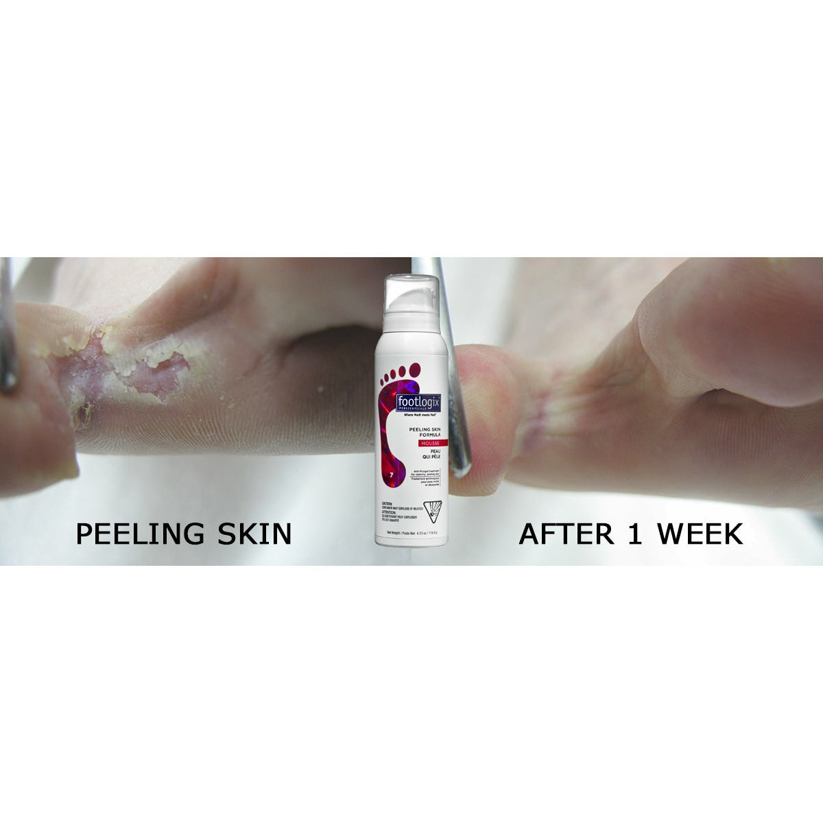 Footlogix | Peeling Skin Formula tegen vervellende voeten en voetschimmel