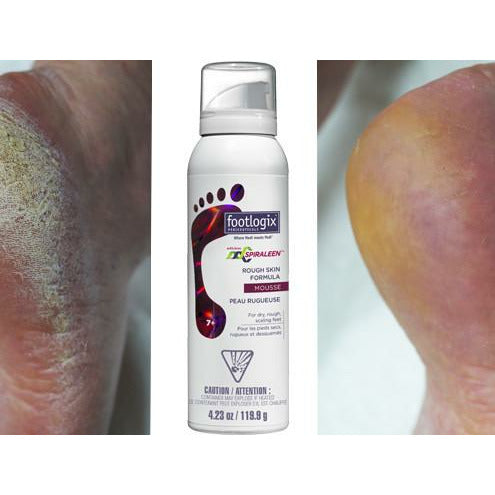 Footlogix | Rough Skin voet mousse tegen ruwe, jeukende voeten en voetschimmel