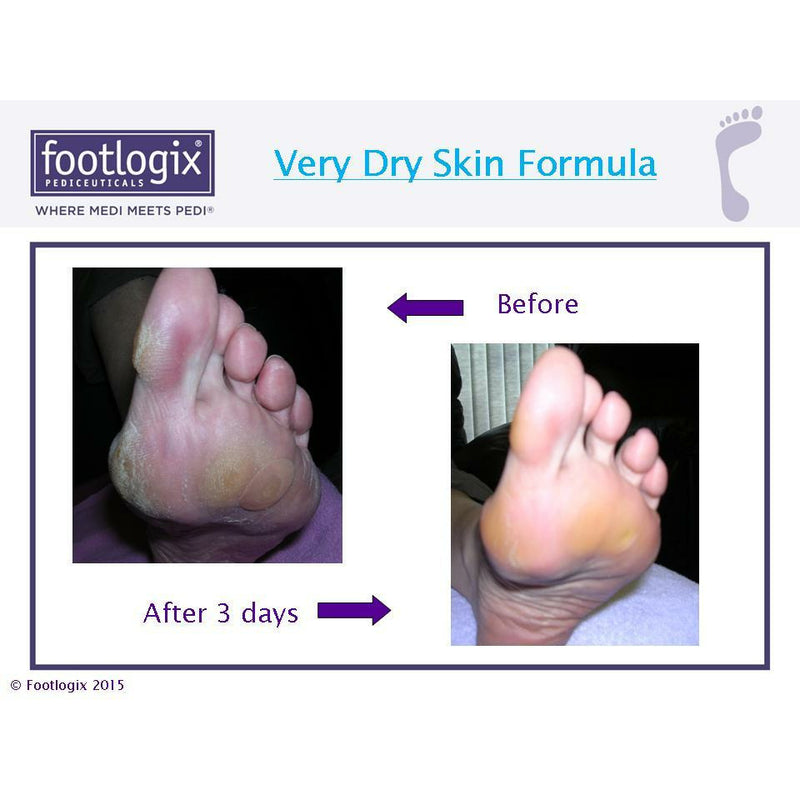 Very Dry Skin voet mousse voor droge voeten